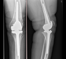 RTG závěsné endoprotézy levého kolena